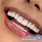 مزایا و معایب انواع روکش دندان